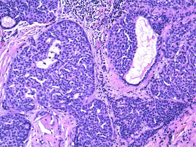 Pathology Outlines - Neuroendocrine Tumor